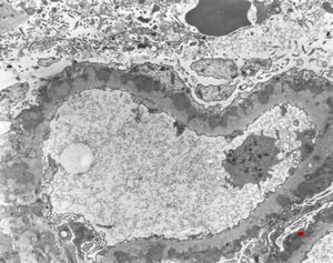 F,12y. | membranous glomerulopathy - lupus erythematodes st. V